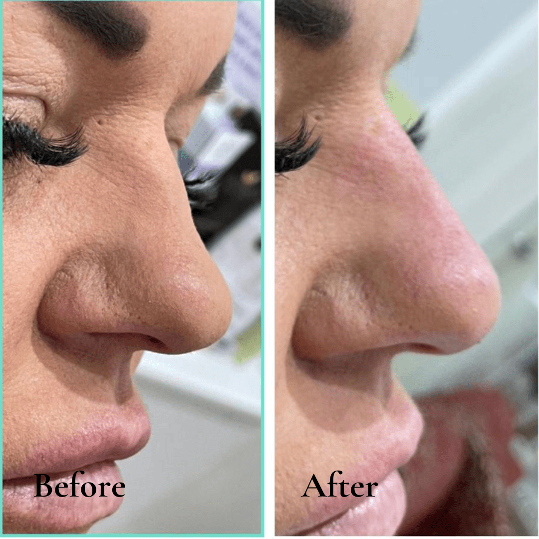 aesthetic clinic before and after photo