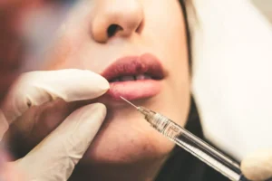 Lip Filler Trends in 2024