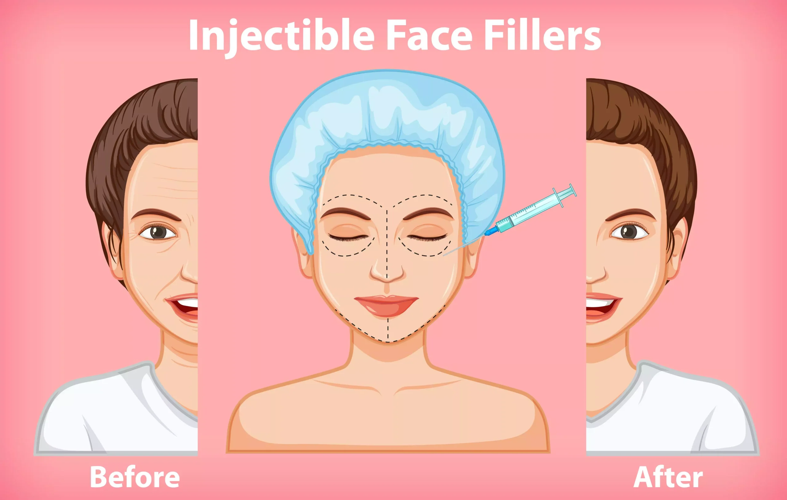 wrinkle injections