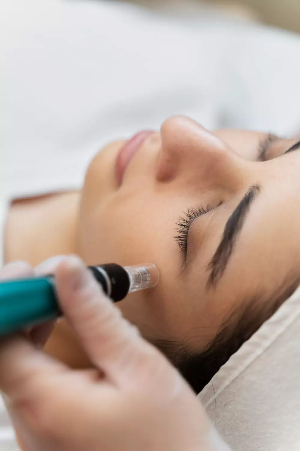 How Effective Is Microneedling For Acne Scars