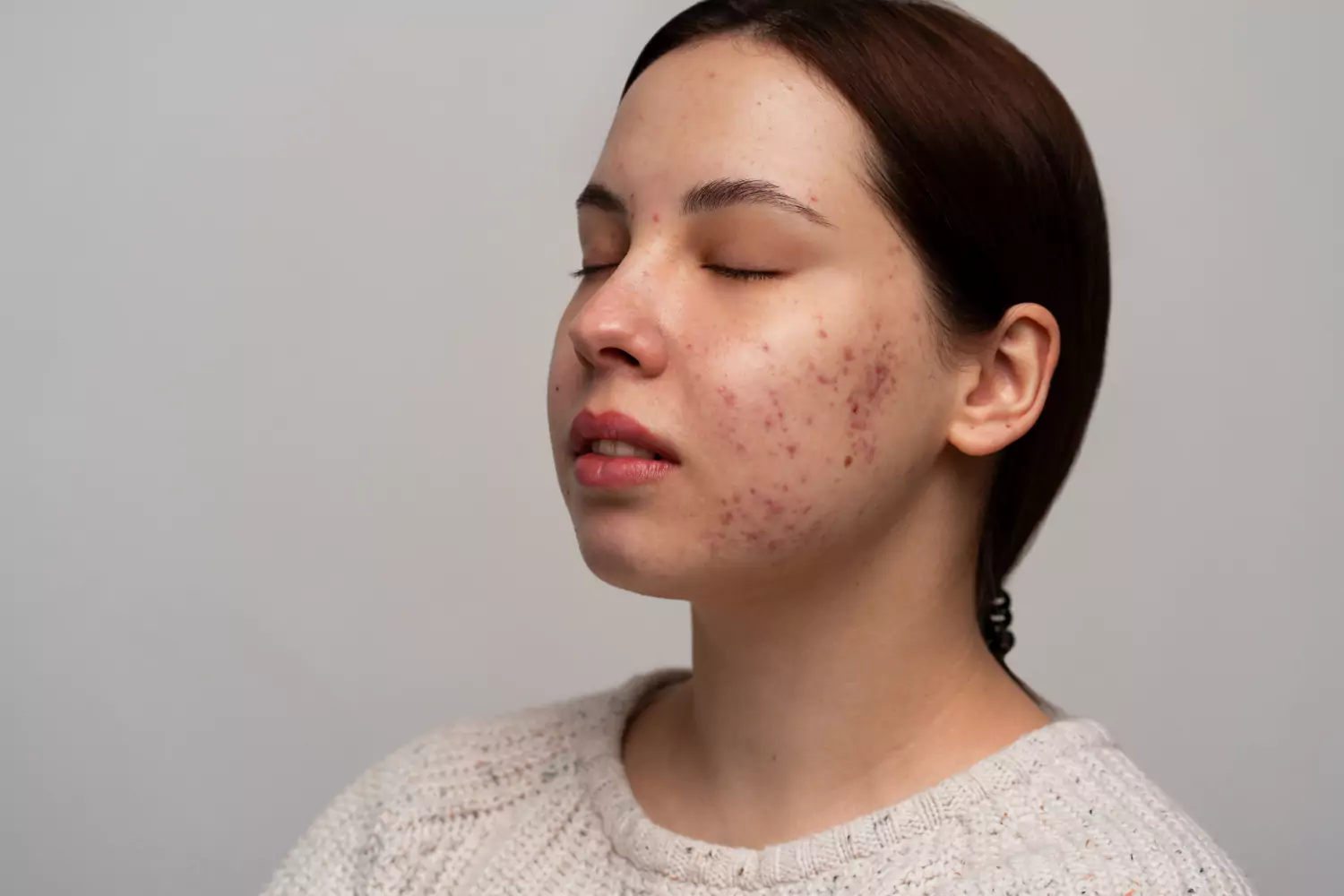 Say Goodbye to Acne Scars with Dermisonic Therapy