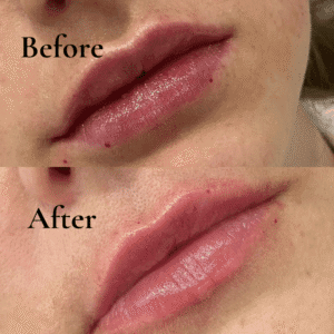 lip fillers before and after