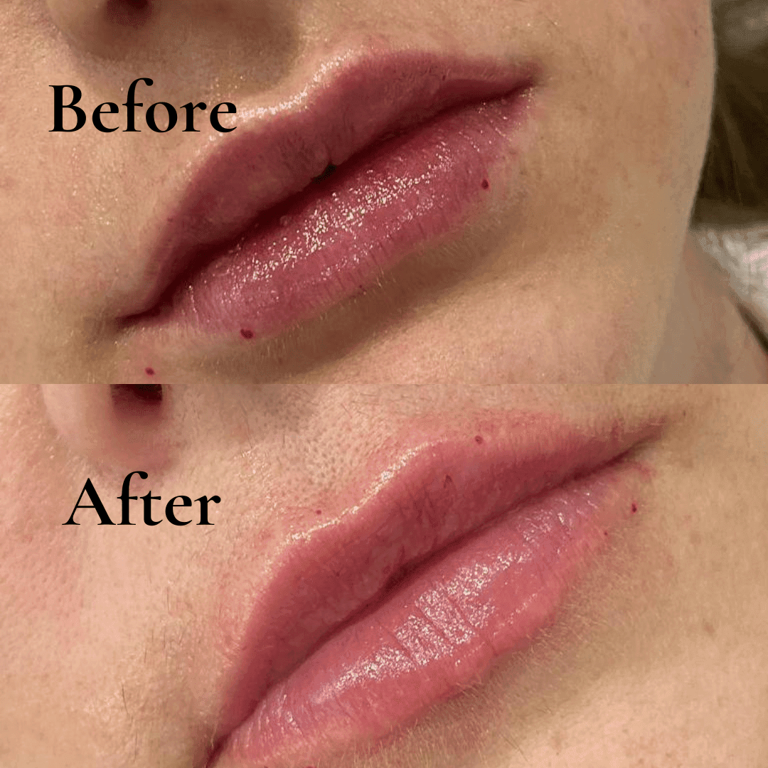 lip fillers before and after
