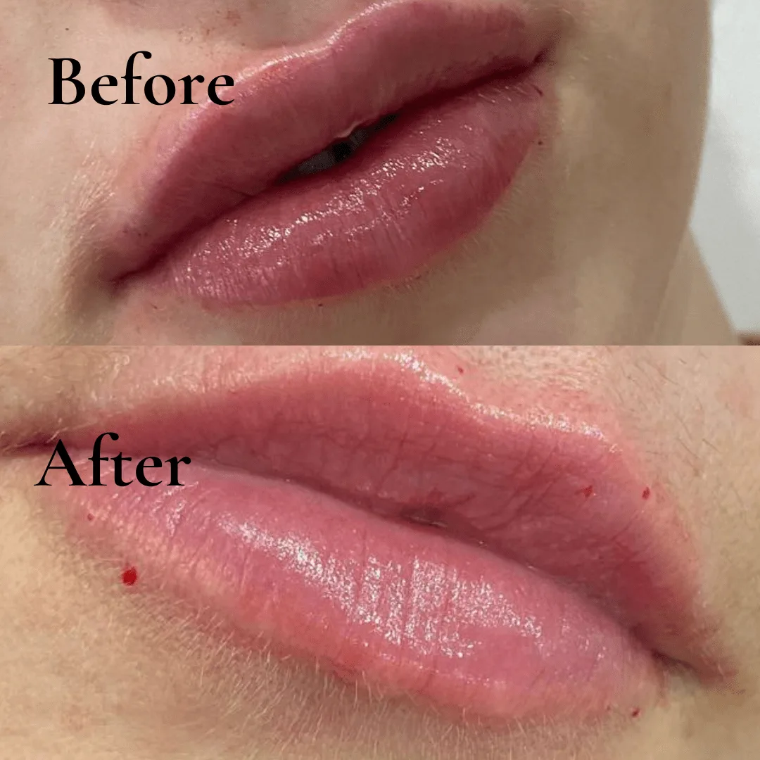 lip fillers