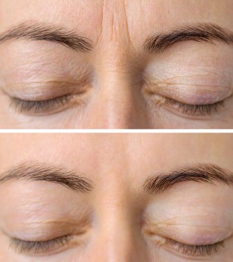 anti aging injections