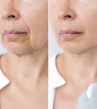 anti wrinkle injections before and after in brighton
