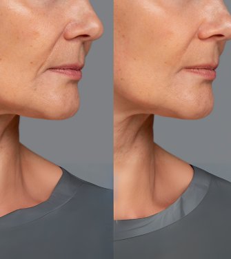 anti wrinkle injections near me