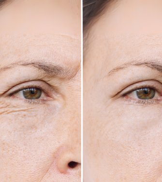 anti wrinkle injections 3 areas