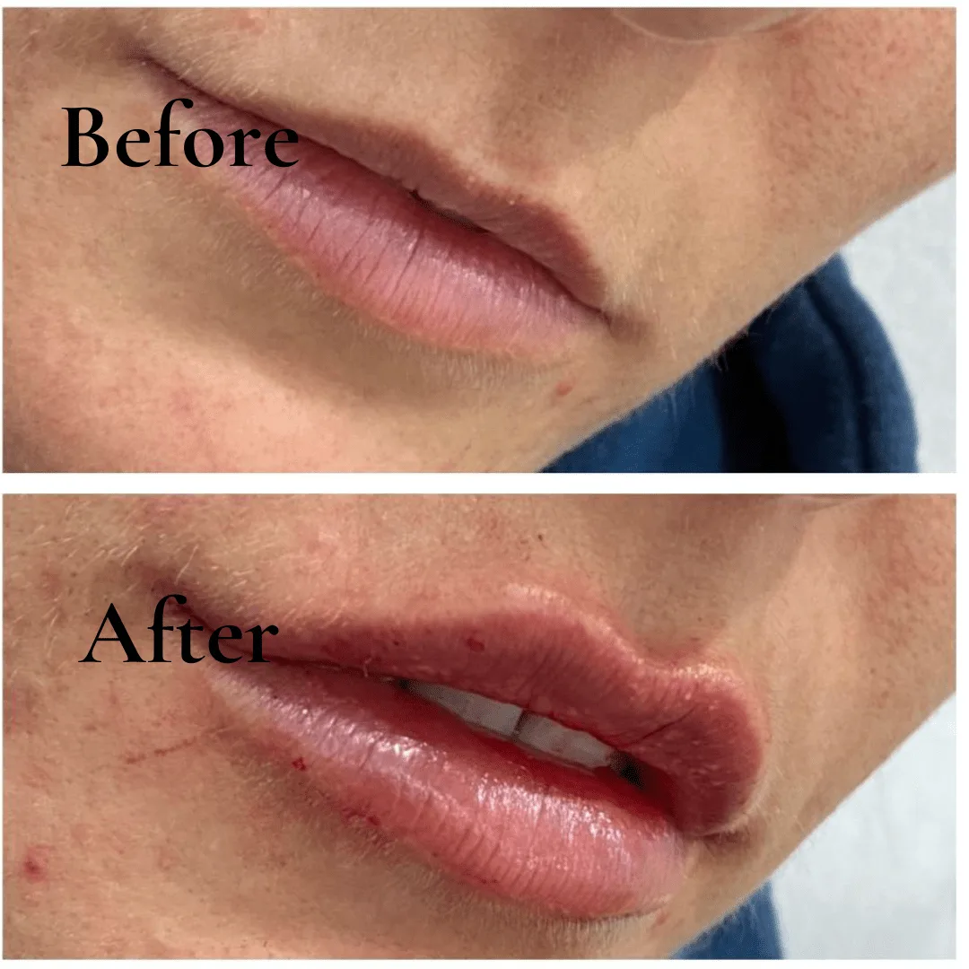 lip fillers results