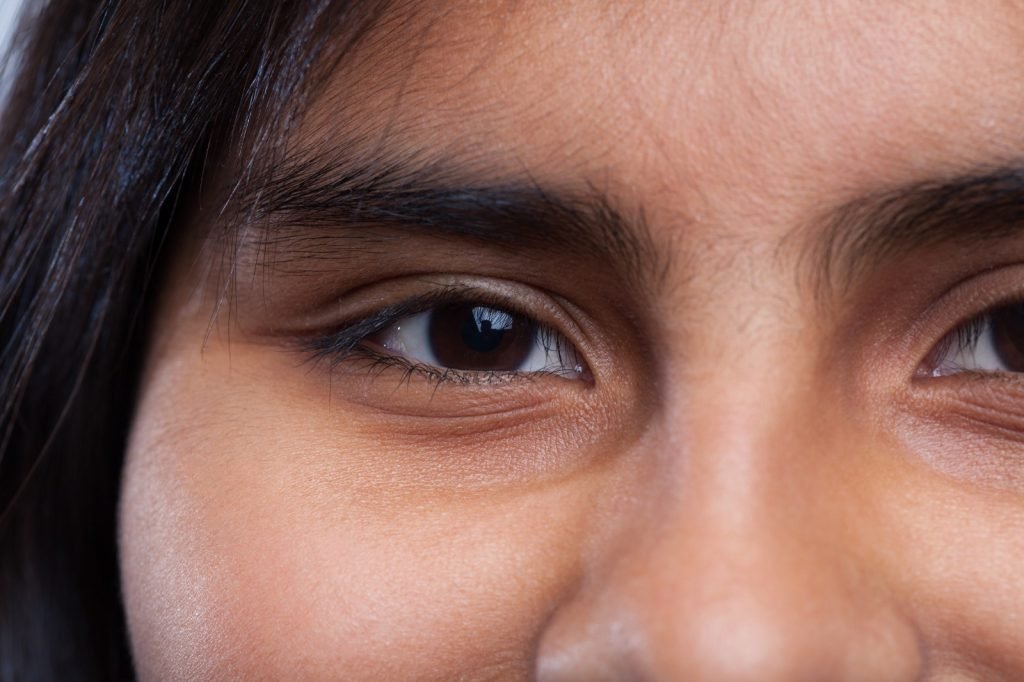 under eye fillers in Brighton