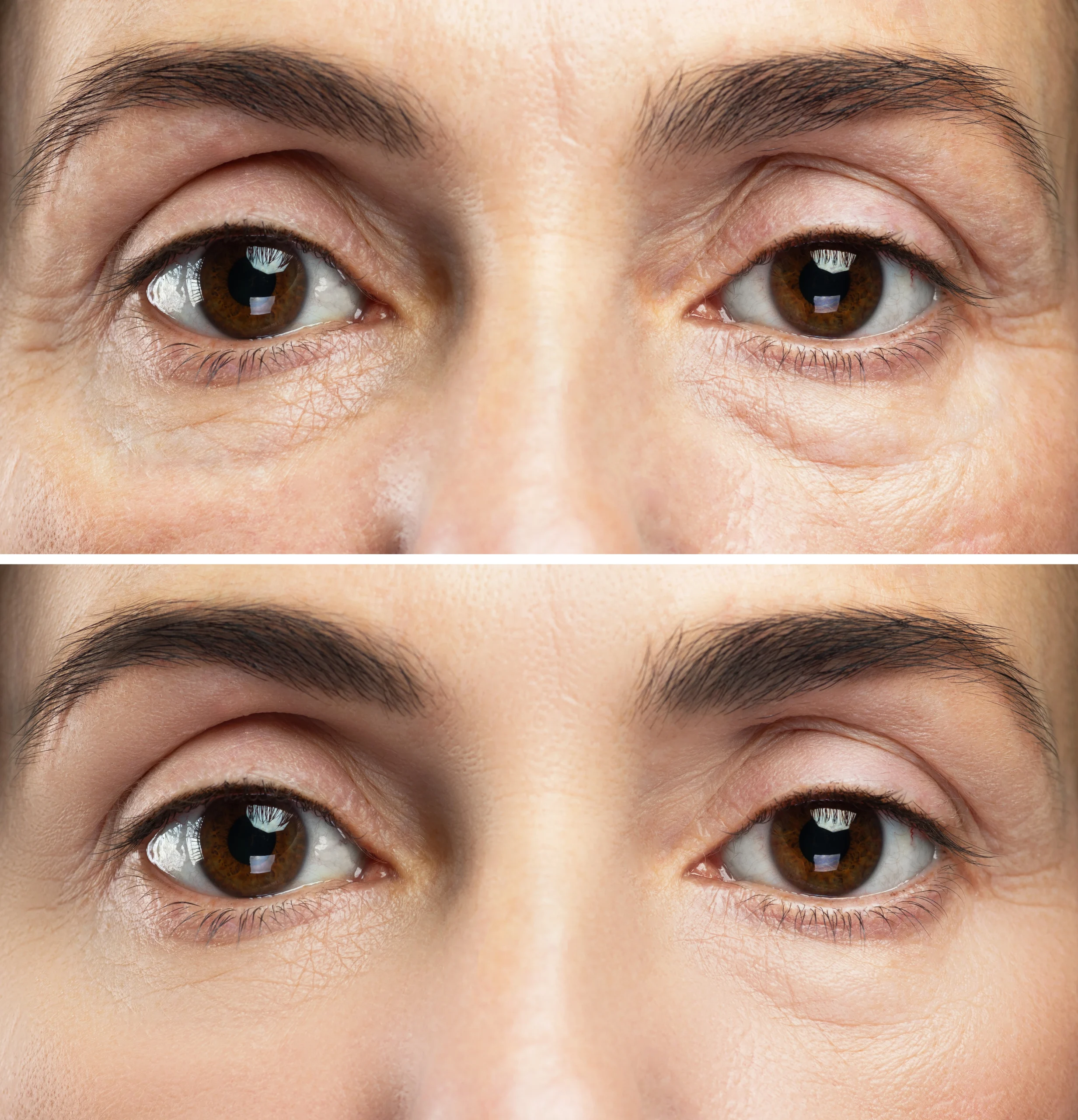 anti-aging-treatment-comparison-female-eyes-before-after-rejuvenation