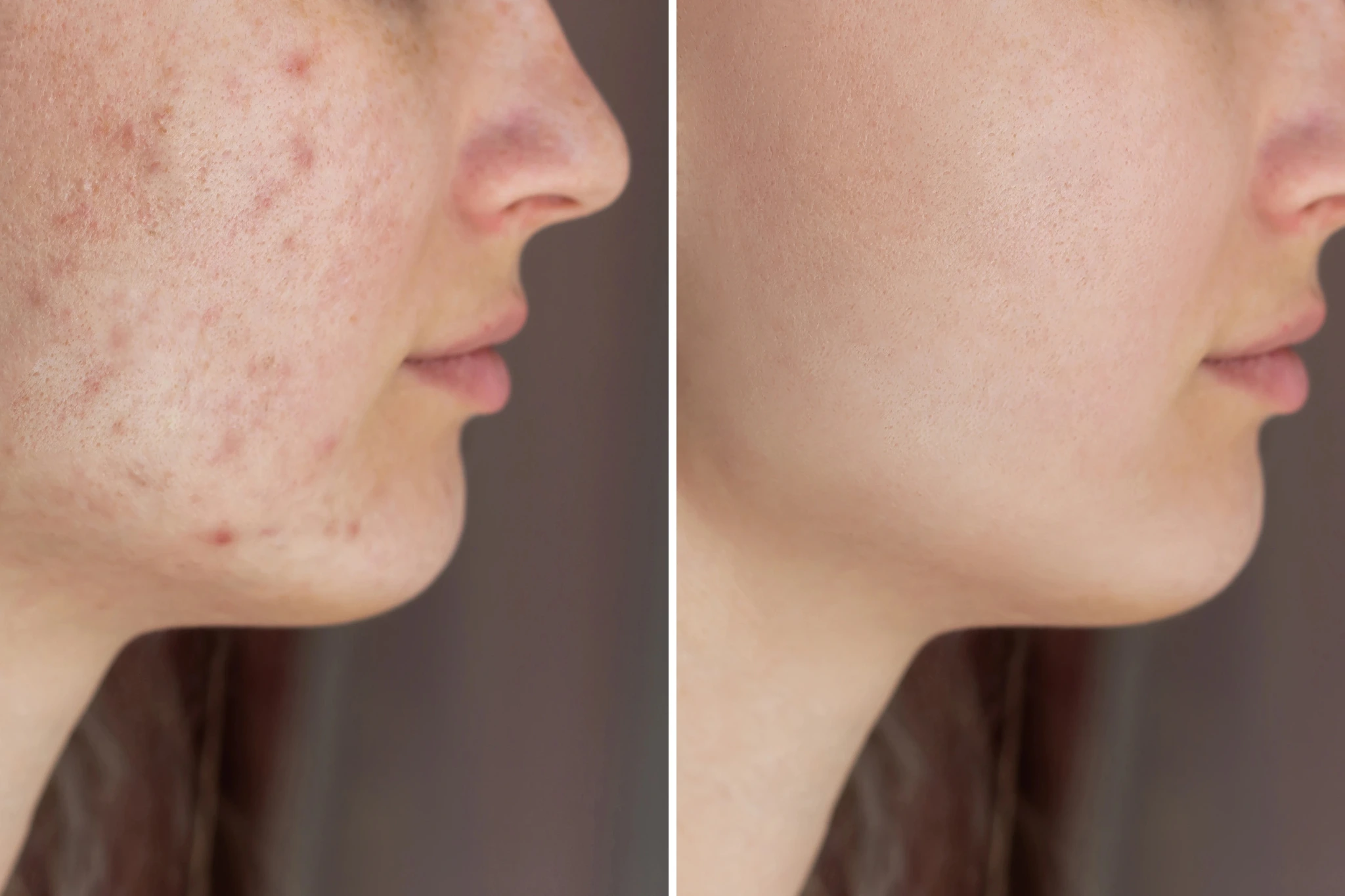 exosome treatment in brighton