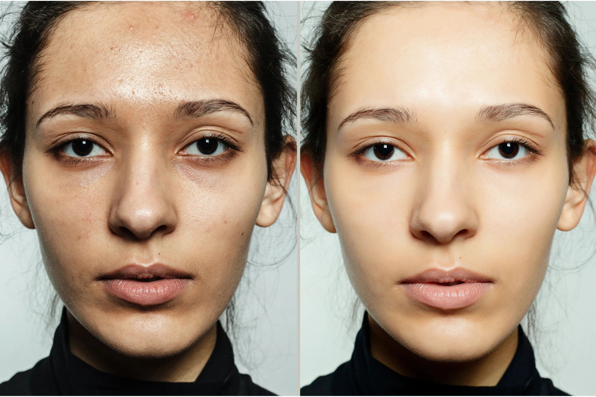 exosomes injections in brighton