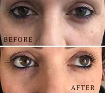 lumi eyes before and after