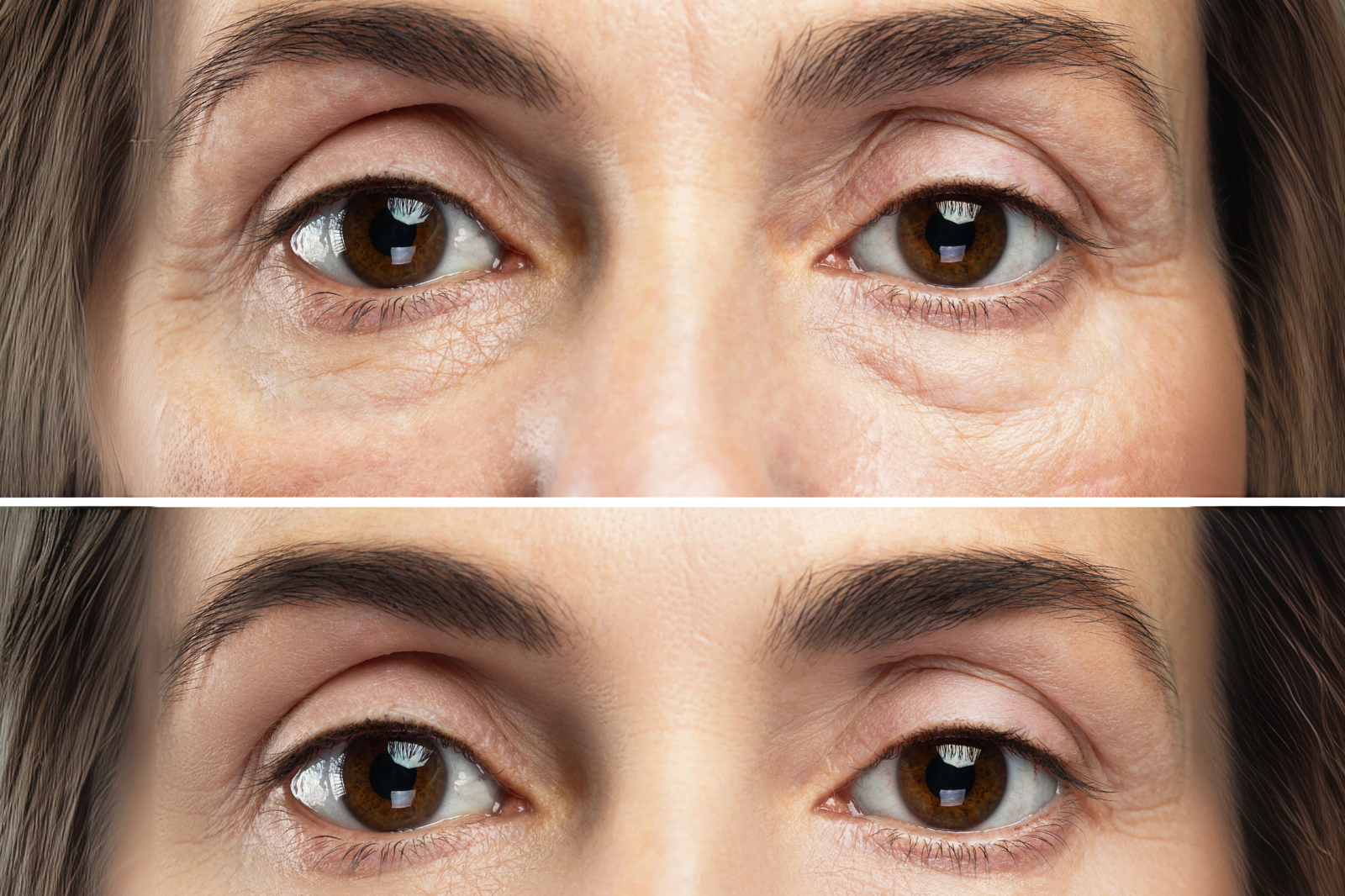 tear trough before and after