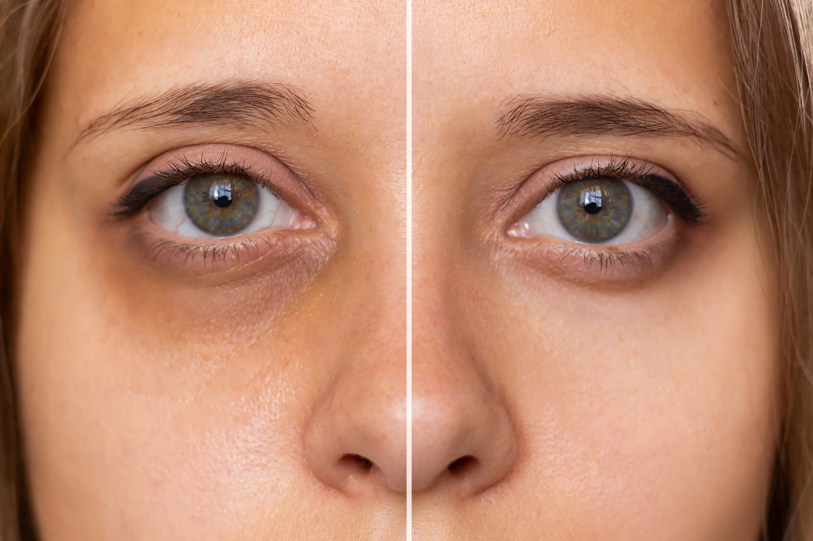 tear trough fillers in brughton