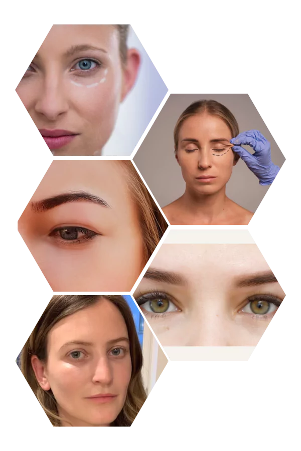 Dermal Fillers in Brighton