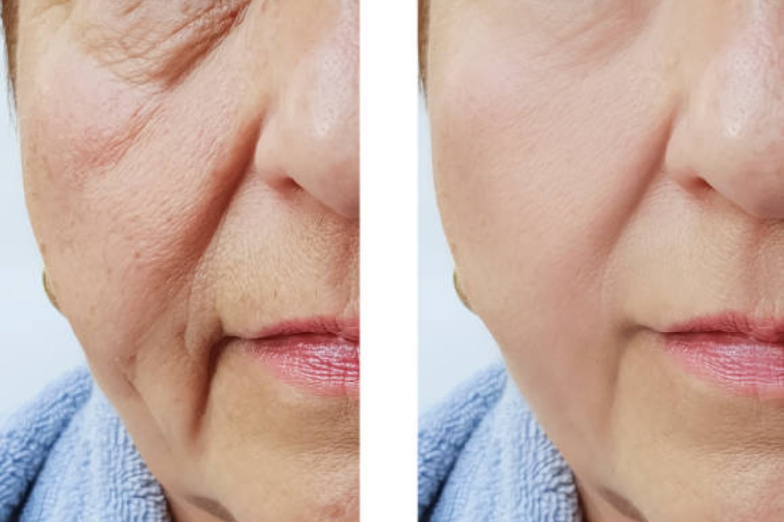 filler botox brighton