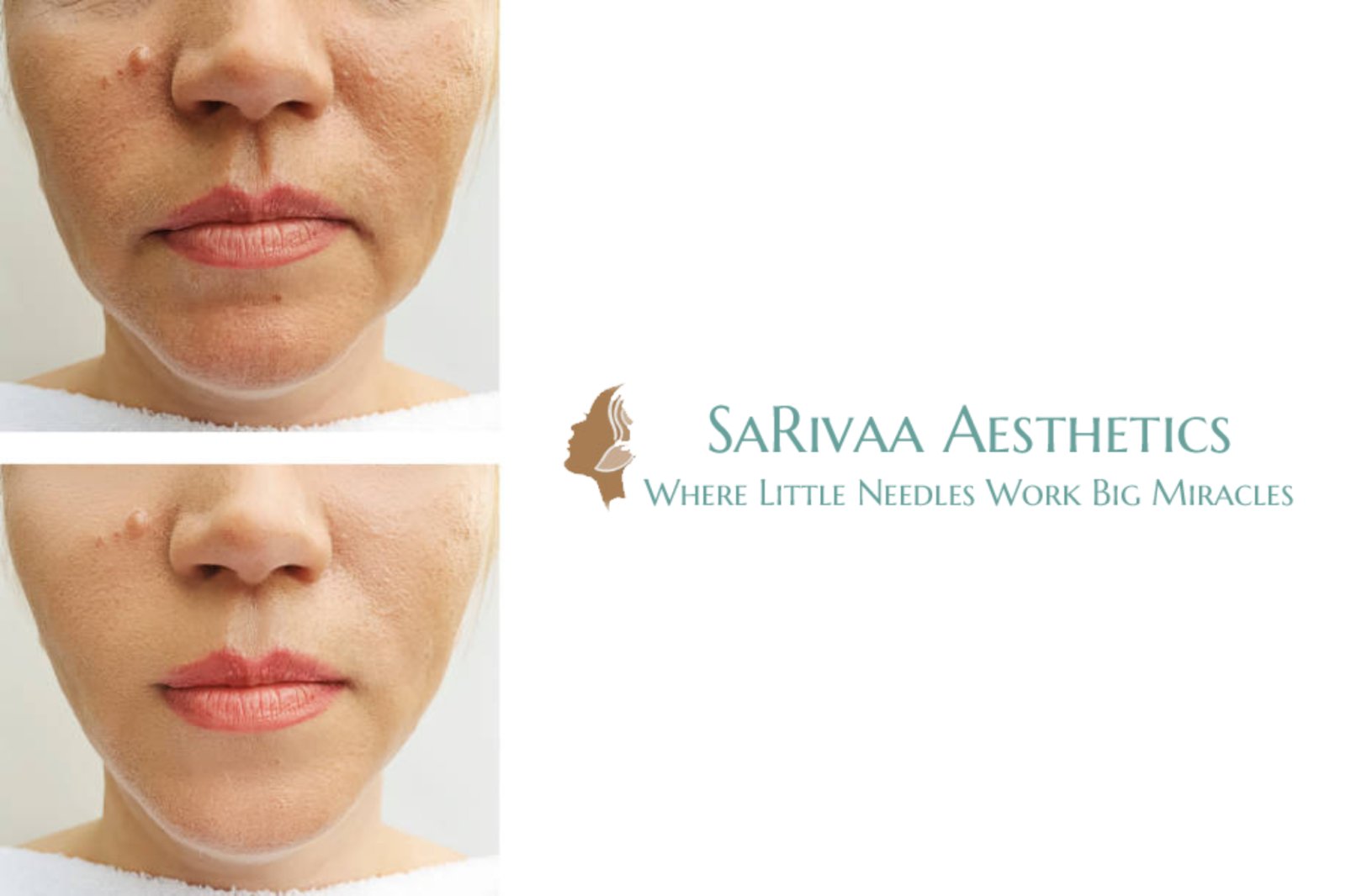 botox filler before after​