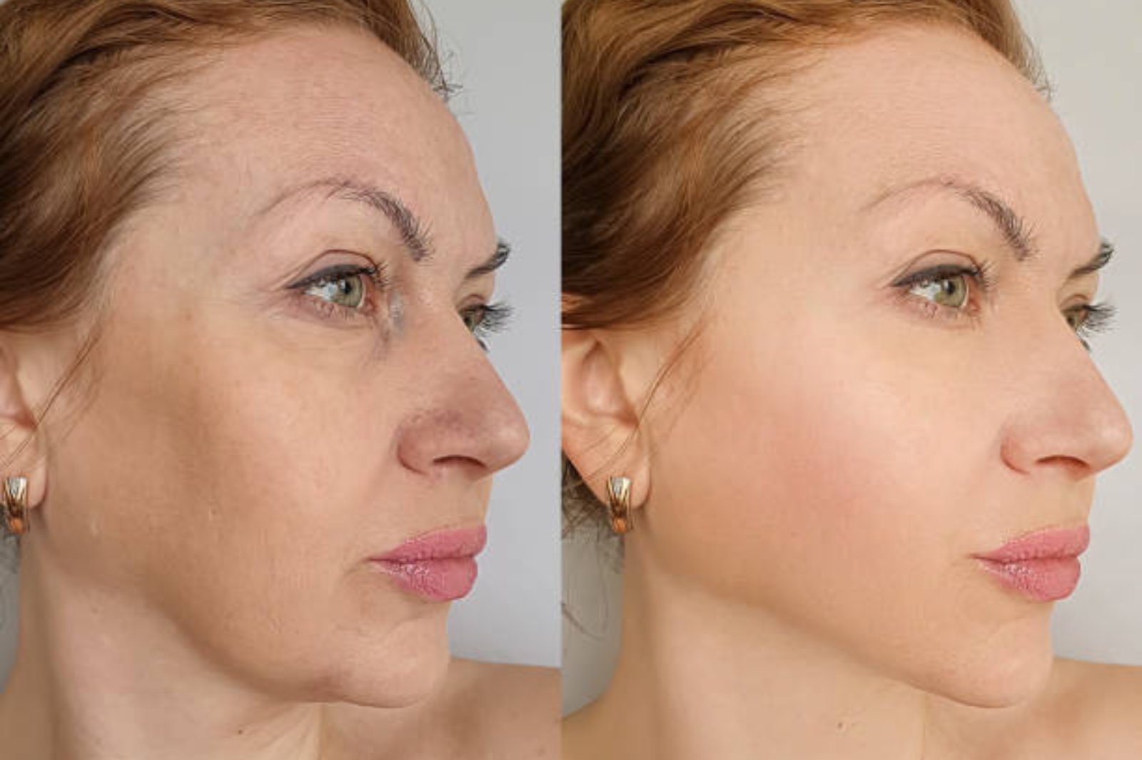botox and fillers​ in brighton