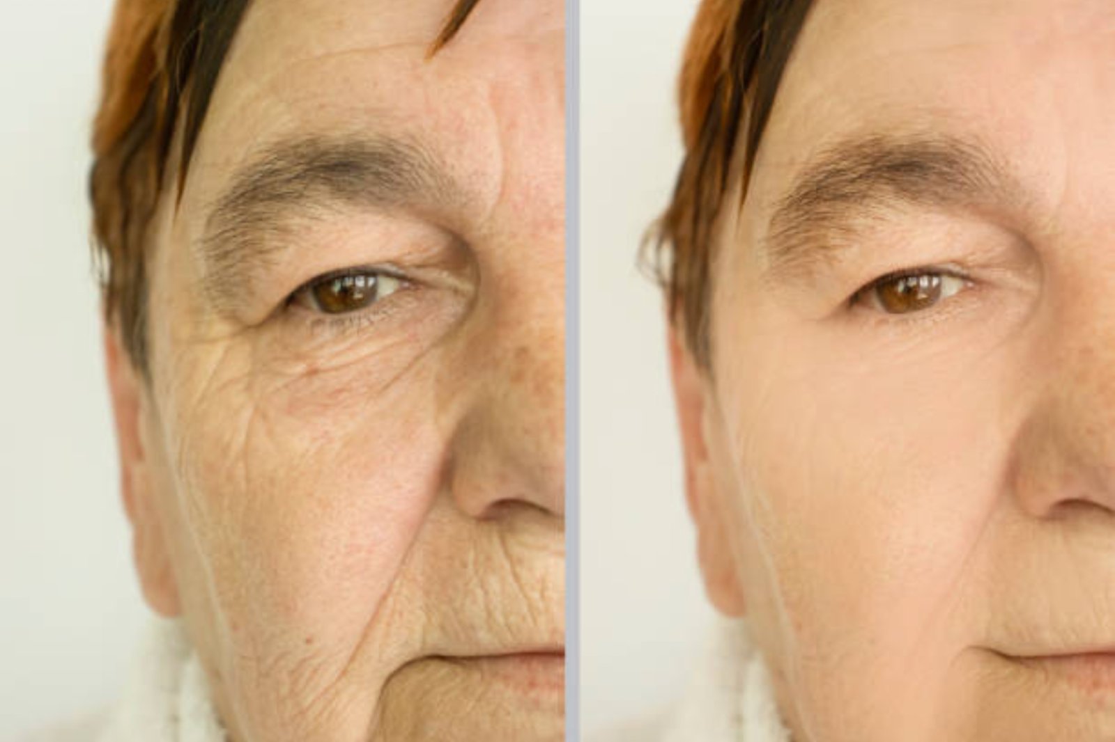 botox and fillers​ brighton