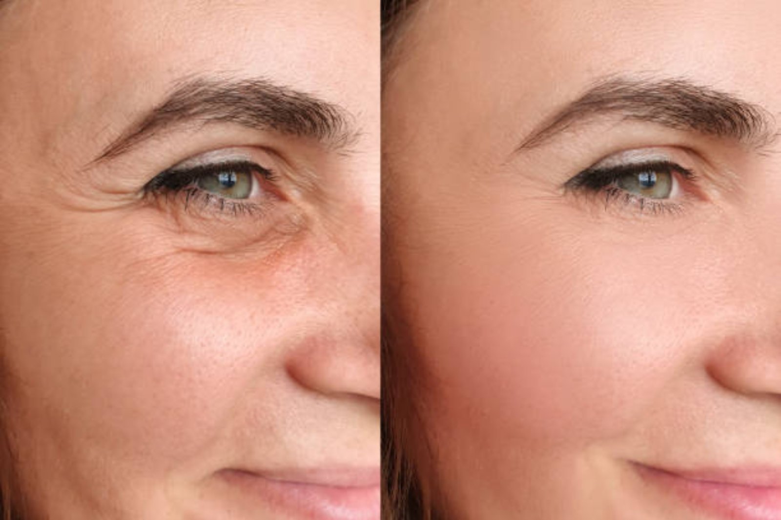 botox vs fillers​ in Brighton