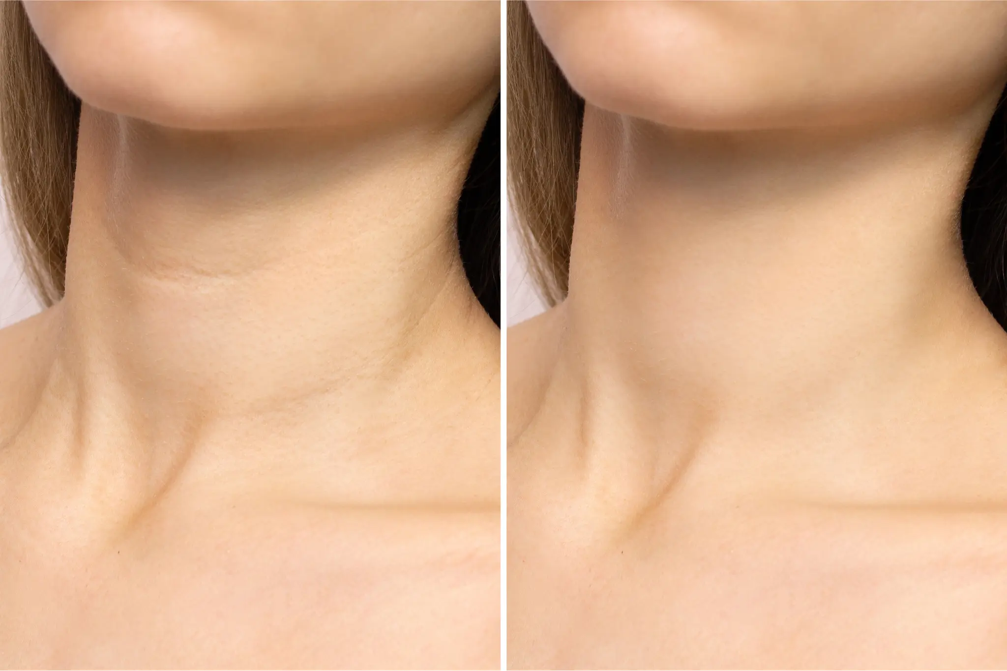 collagen treatment in brighton and hove