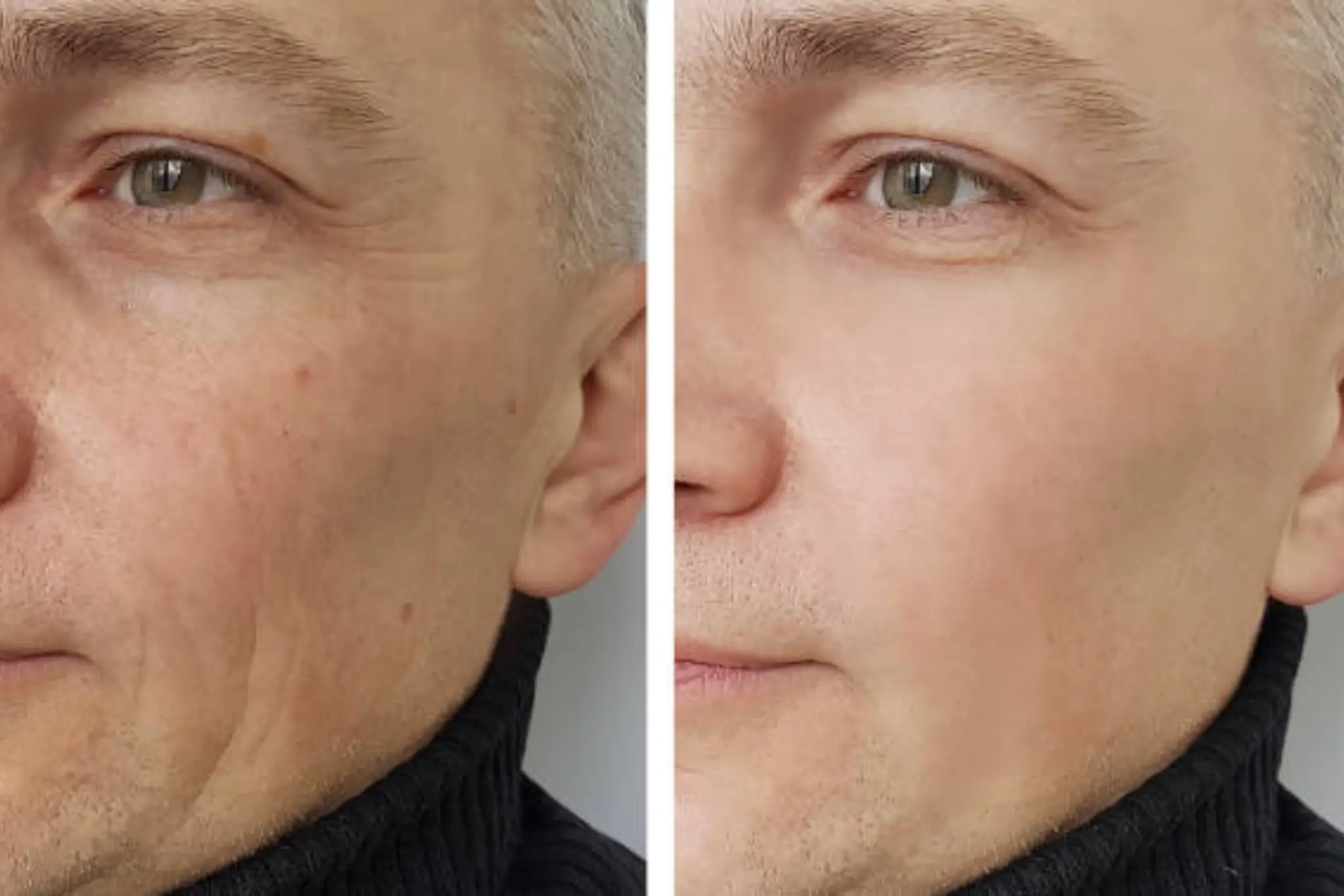 collagen treatment brighton