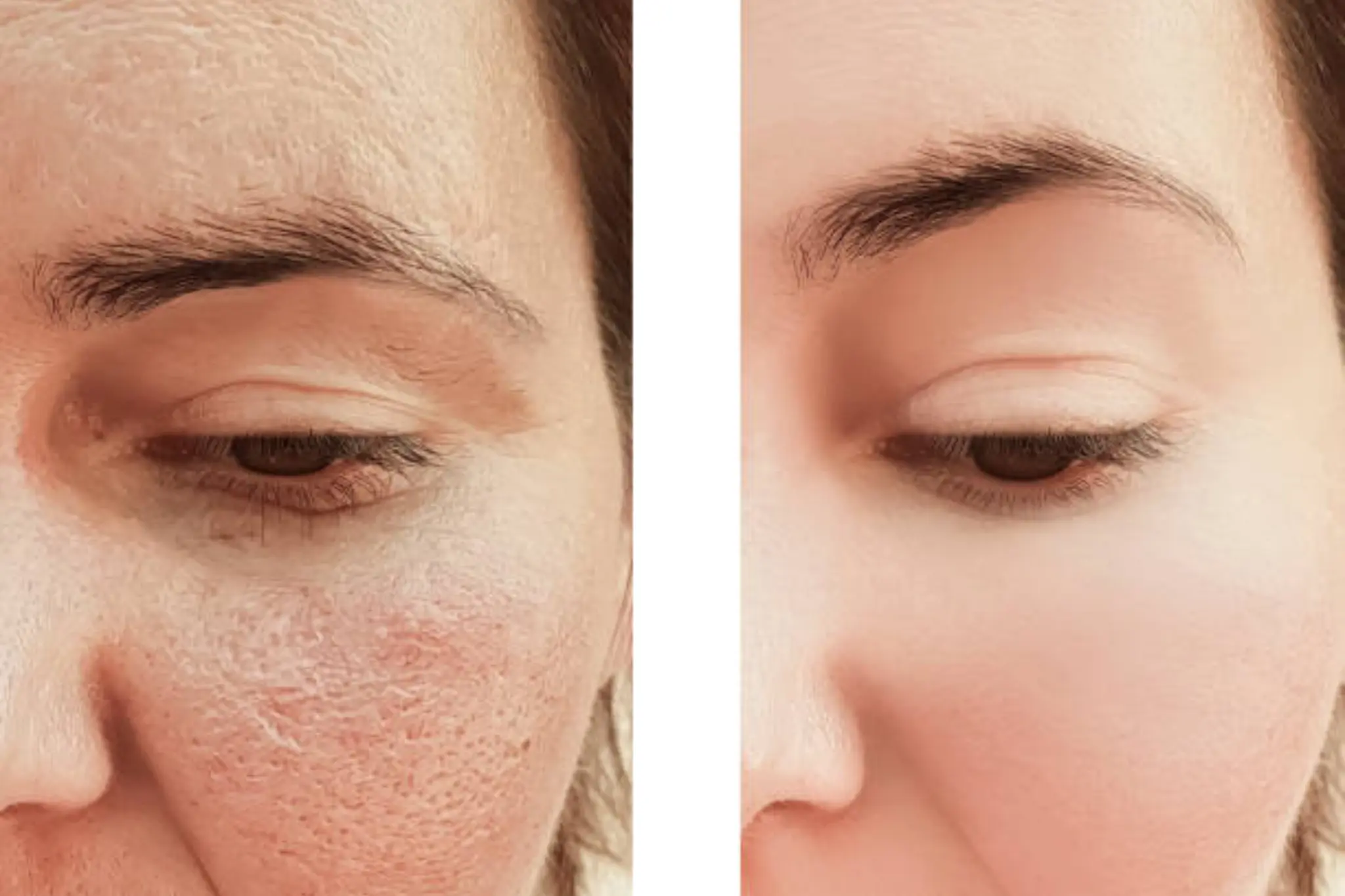 collagen induction therapy treatment