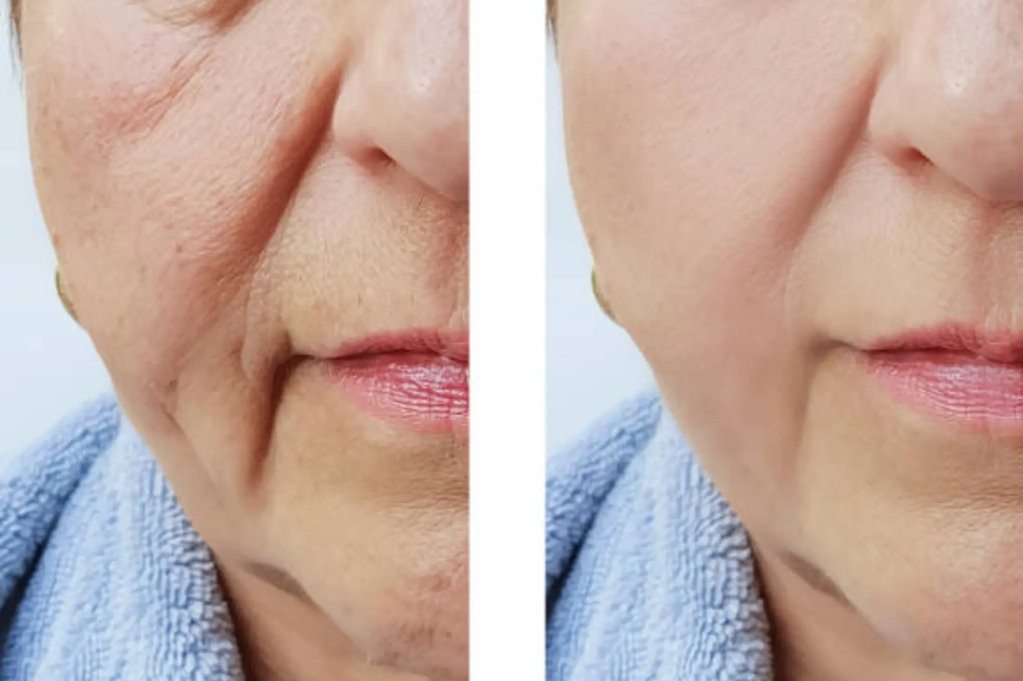 collagen in brighton and hove