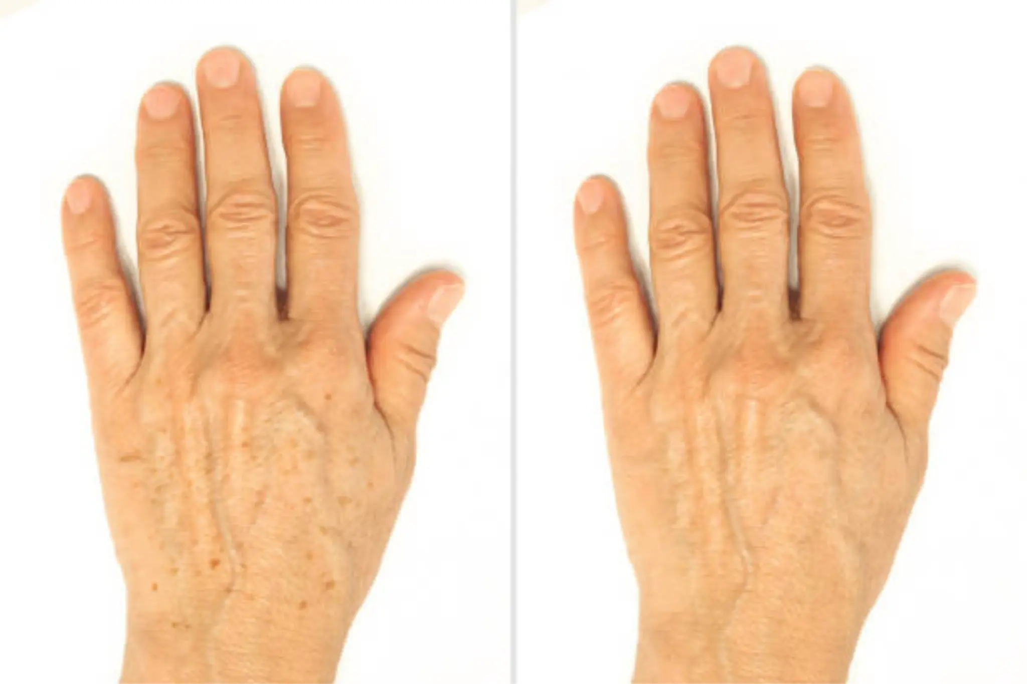 collagen therapy before and after