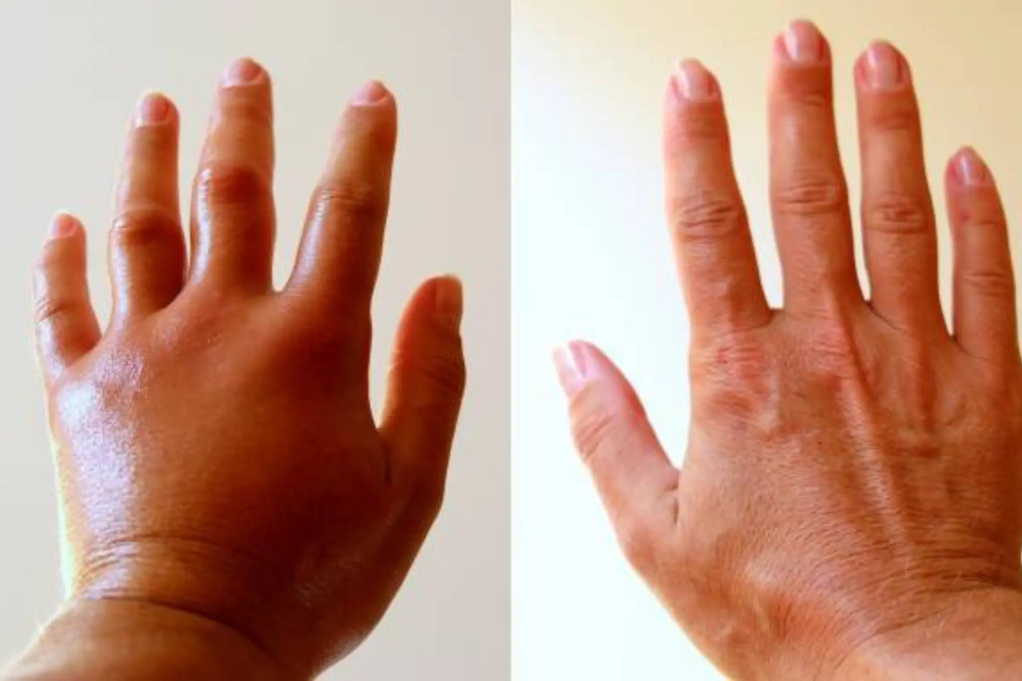 collagen treatment before and after