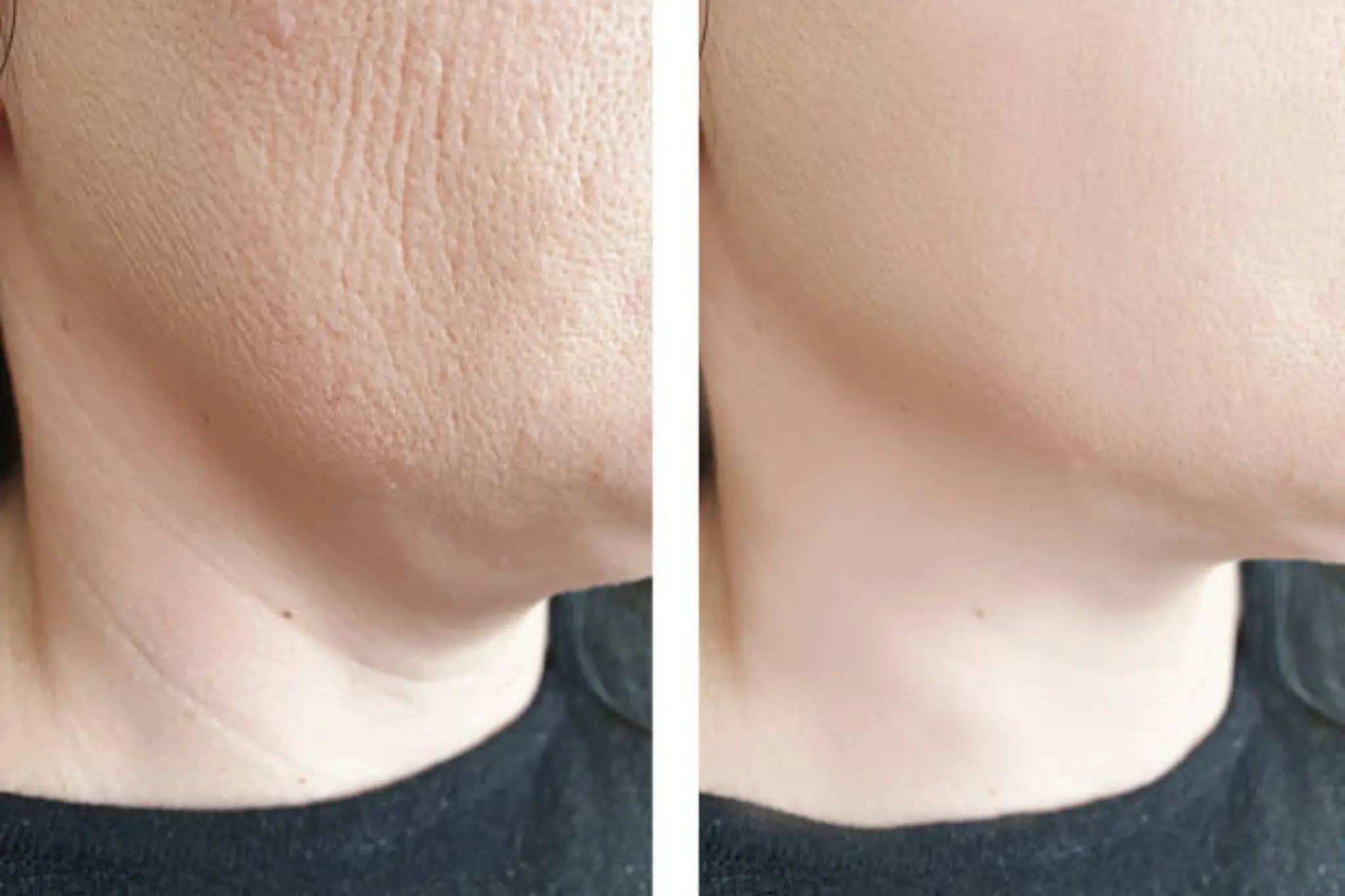 collagen facial treatment in brighton