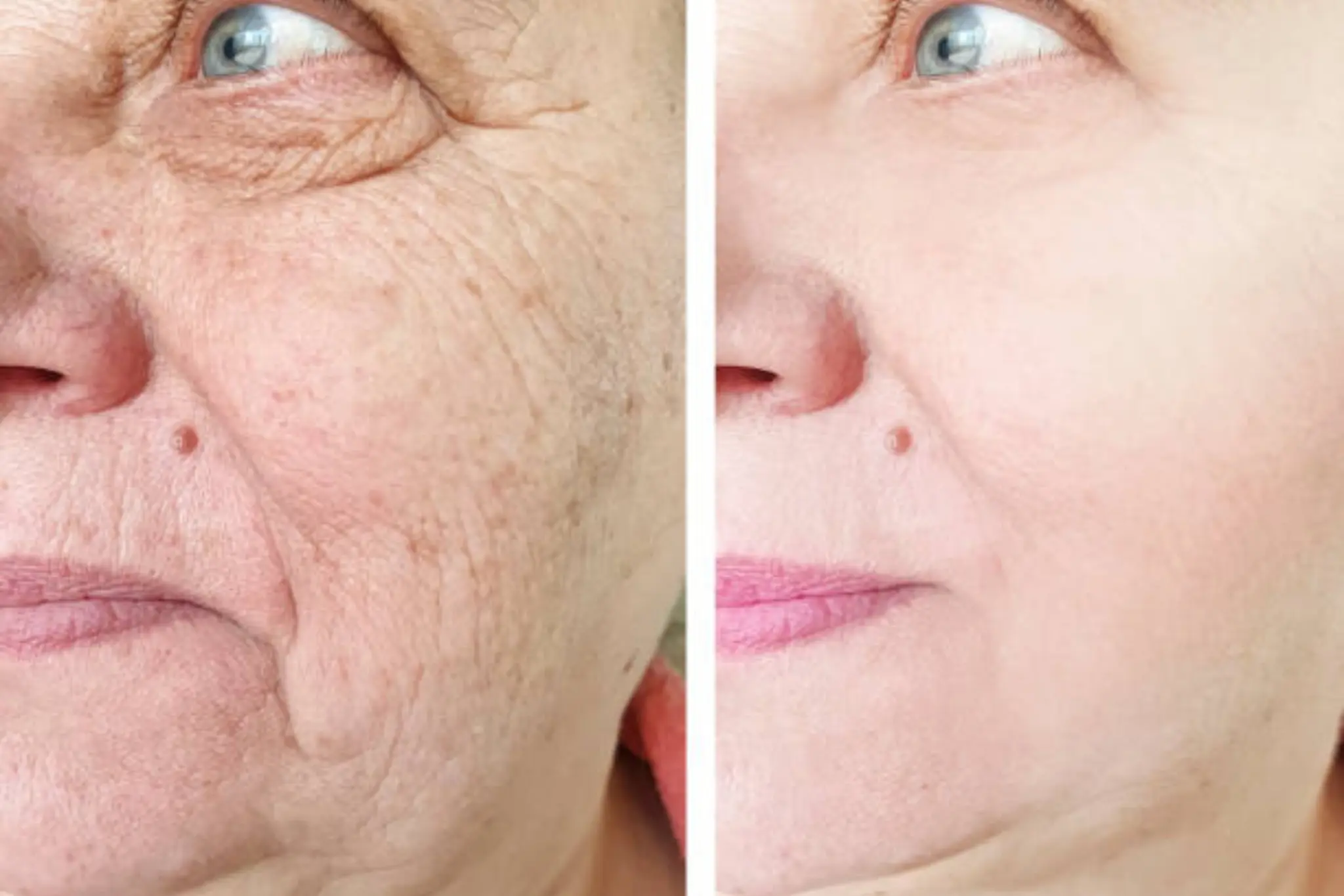 collagen treatment for face