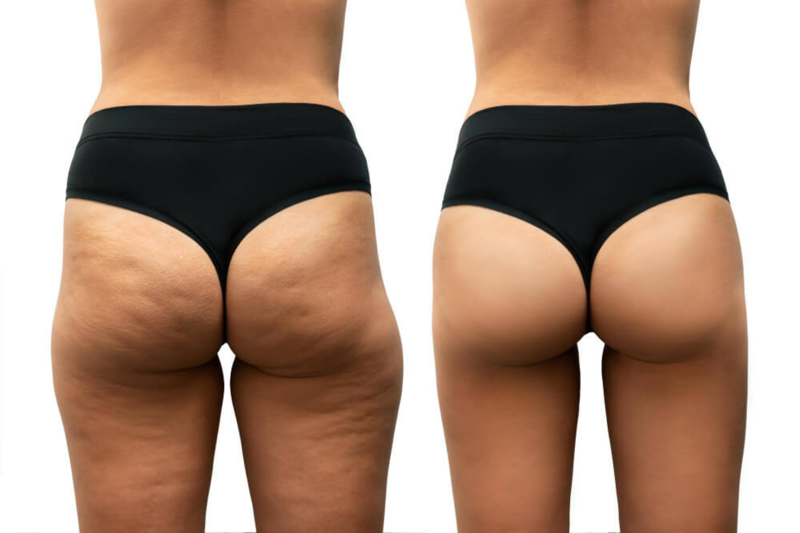 lanluma bum treatments Brighton