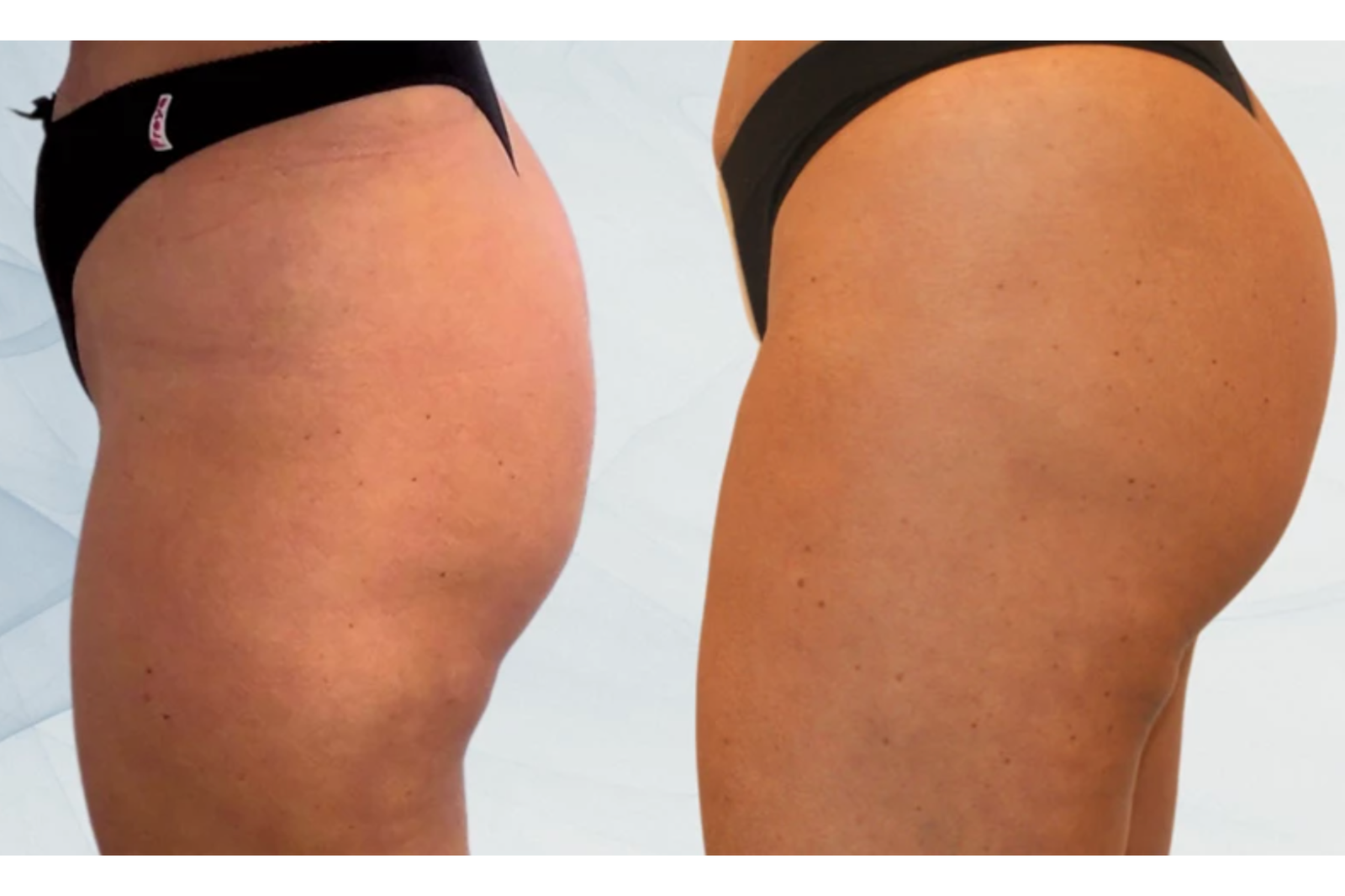 plla filler in brighton