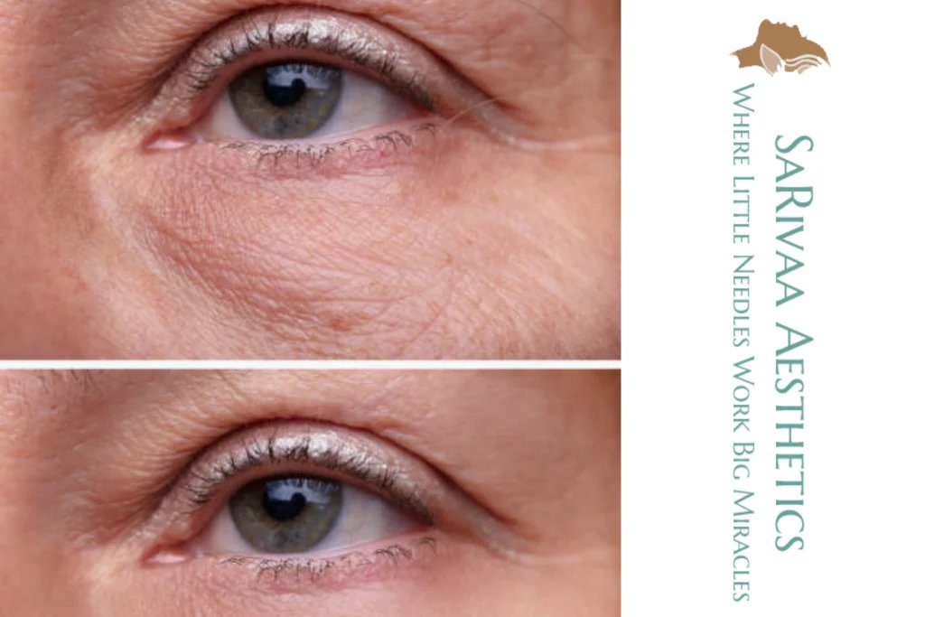 sculptra under eyes​