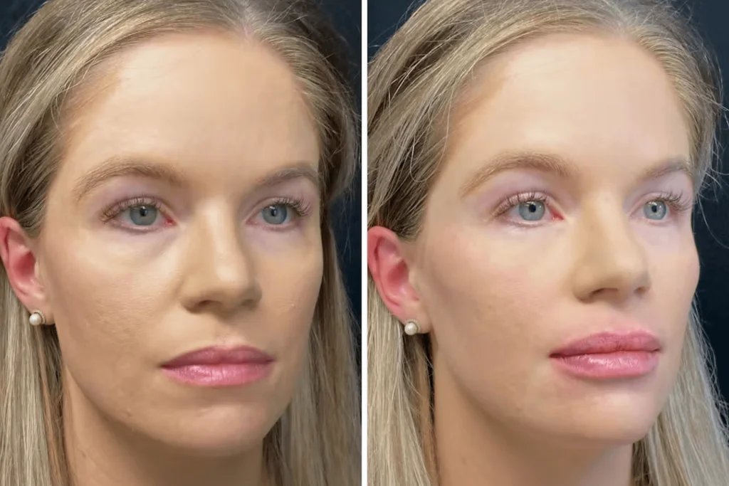 8 point face lift cost