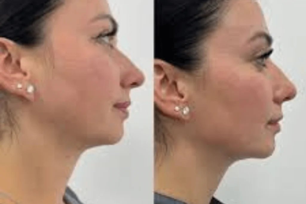 8 point face lift near me