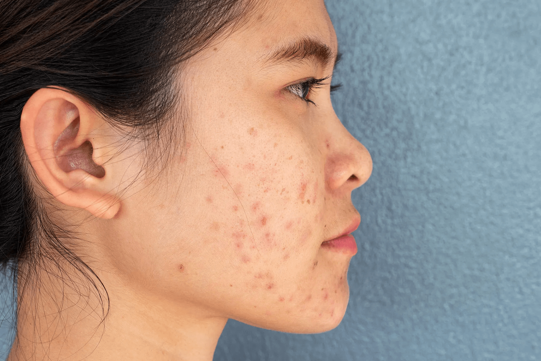 Acne Scarring Treatment