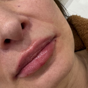 Natural Lip Enhancement: The Modern Alternative to Overfilled Lips