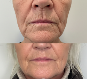 Botox for Smokers’ Lines: A Complete Treatment Guide