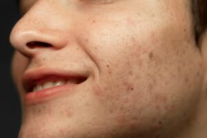 Post-Inflammatory Hyperpigmentation: Causes and Summer Care Tips